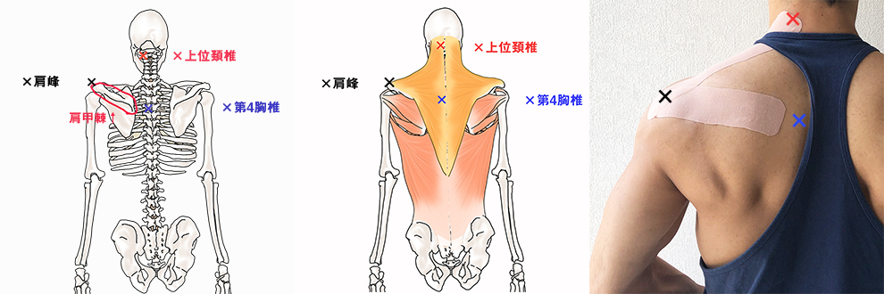 僧帽筋（上部・中部）のサポートテーピング