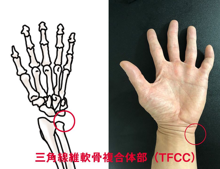 三角線維軟骨複合体損傷（TFCC損傷）のテーピング